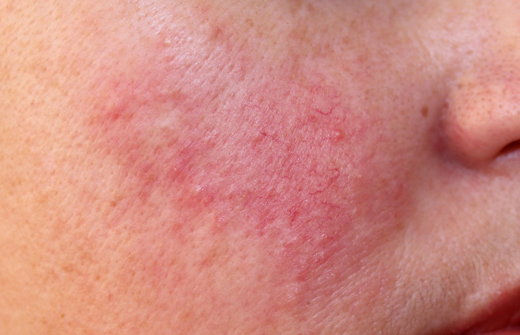 Rosacea: Causes, Symptoms and Treatments